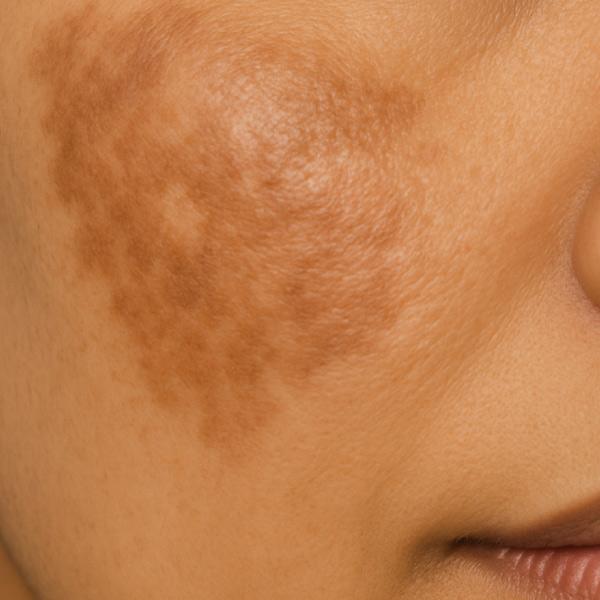 Melasma