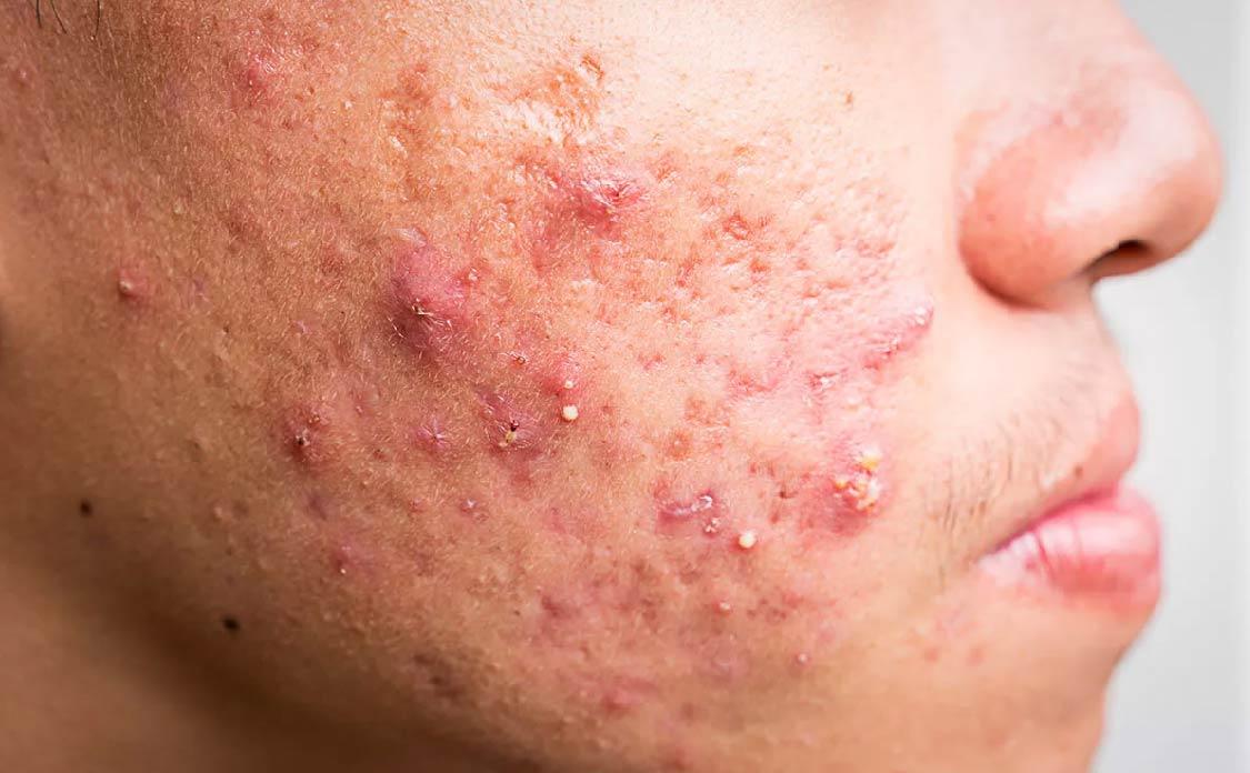 BioCare Acne and Oil Control Moisturizing Gel