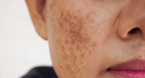 Premium Melasma Cure Set