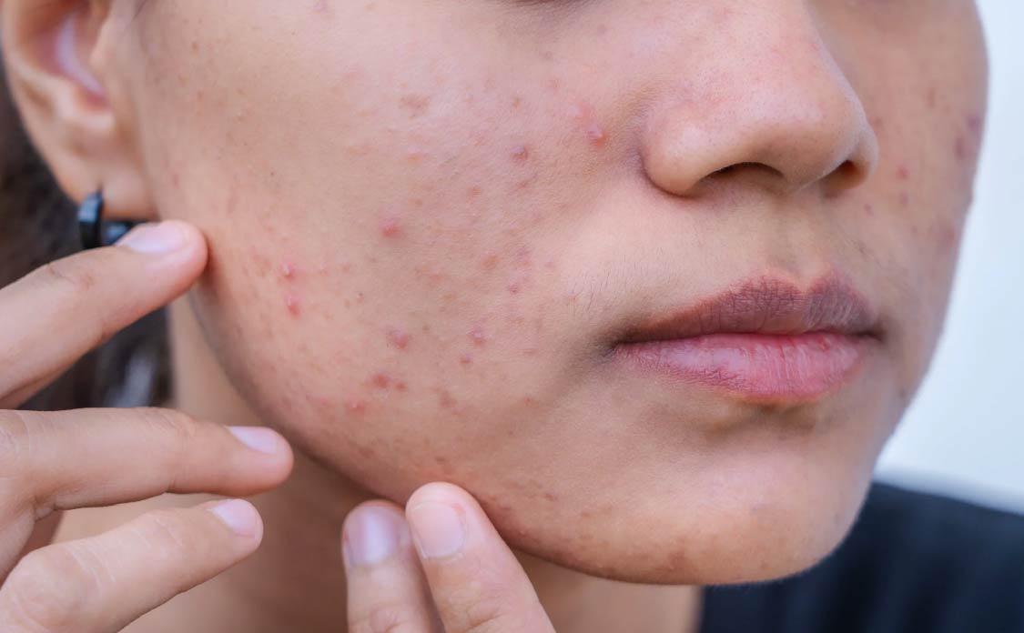 BioCare Handmade Anti-Acne Beauty Bar with Salicylic Acid and Green Tea Extract